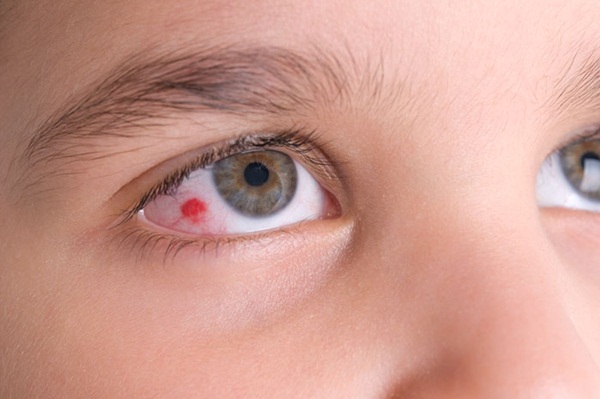 High resolution macro photo of an infected eye of a child.